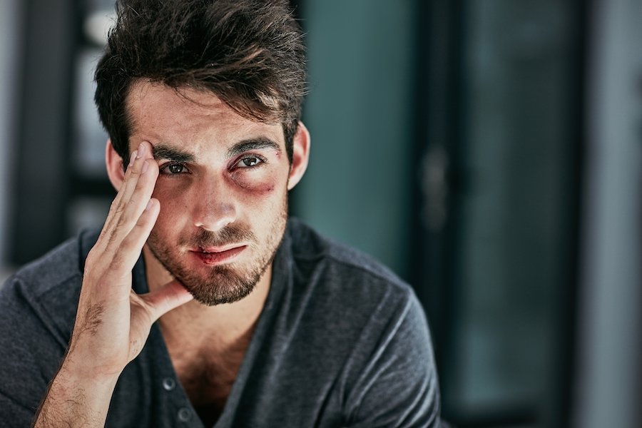 Male domestic violence victim with a black eye and looking forlorn